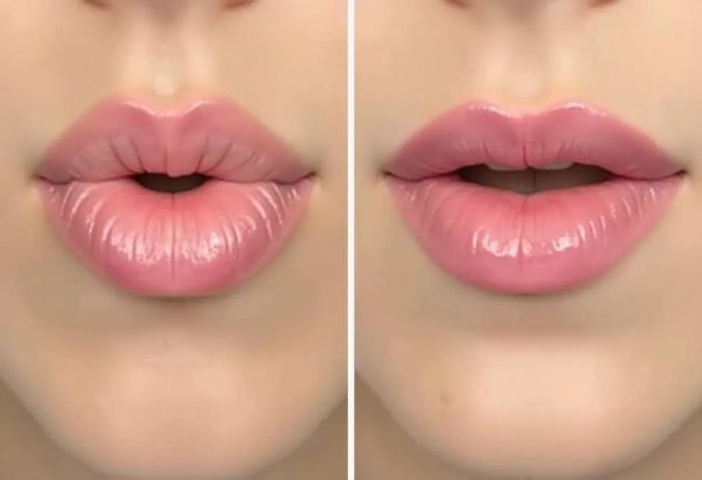 Lip filler