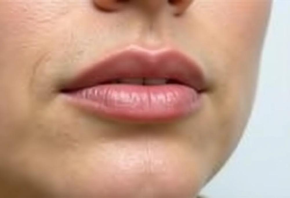 Lip filler